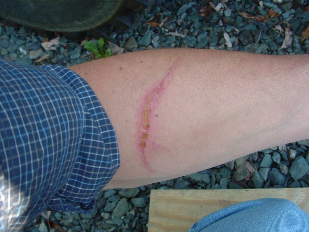 pressure washer injury